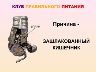 КЛУБ ПРАВИЛЬНОГО ПИТАНИЯ



             Причина -


          ЗАШЛАКОВАННЫЙ
             КИШЕЧНИК
 