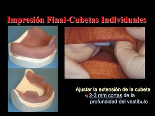 Impresiόn Final-Cubetas Individuales

Ajustar la extensión de la cubeta
"   2-3 mm cortas de la
profundidad del vestíbulo

 