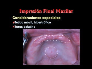 Impresión Final Maxilar
Consideraciones especiales:
"  Tejido mόvil, hipertrόfico
"  Torus palatino

 