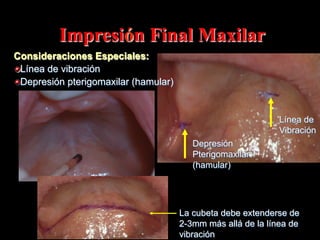 Impresión Final Maxilar
Consideraciones Especiales:
"  Línea de vibraciόn
"  Depresiόn pterigomaxilar (hamular)

Línea de
Vibración
Depresiόn
Pterigomaxilar
(hamular)

La cubeta debe extenderse de
2-3mm más allá de la línea de
vibraciόn

 