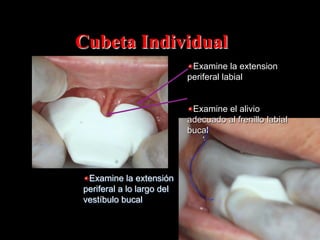 Cubeta Individual
" Examine la extension
periferal labial
" Examine el alivio
adecuado al frenillo labial
bucal

" Examine la extensión
periferal a lo largo del
vestíbulo bucal

 