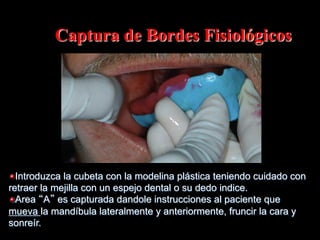 Captura de Bordes Fisiológicos

"  Introduzca la cubeta con la modelina plástica teniendo cuidado con
retraer la mejilla con un espejo dental o su dedo indice.
" Area A es capturada dandole instrucciones al paciente que
mueva la mandíbula lateralmente y anteriormente, fruncir la cara y
sonreír.

 