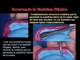 Recortando la Modelina Plástica
" Cuidadosamente remueva la modelina que ha
penetrado la superficie interna de la cubeta. Dejar
de hacer ésto resultará en una impresión que
desplaza tejidos inadecuadamente.

" Use una cuchilla de mango
rojo tipo bisturí o el raspador
Kingsley (flecha) para
remover la modelina que ha
penetrado la superficie interna
de la cubeta.

 