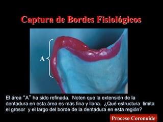 Captura de Bordes Fisiológicos

A

El área A ha sido refinada. Noten que la extensión de la
dentadura en esta área es más fina y llana. ¿Qué estructura limita
el grosor y el largo del borde de la dentadura en esta región?

Proceso Coronoide

 