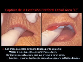 Captura	
  de	
  la	
  Extensión	
  Periferal	
  Labial-­‐Área	
  “C”	
  

"

Las áreas anteriores están modeladas por lo siguiente:
–  Masage	
  al	
  labio	
  superior	
  con	
  un	
  movimiento	
  lateral	
  
Dar	
  instrucciones	
  al	
  paciente	
  para	
  que	
  arrugue	
  la	
  cara	
  y	
  sonría	
  
–  Examine	
  el	
  grosor	
  de	
  la	
  extensión	
  periferal	
  para	
  soporte	
  del	
  labio	
  adecuado	
  

 