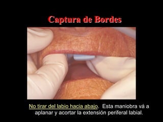 Captura de Bordes

No tirar del labio hacia abajo. Esta maniobra vá a
aplanar y acortar la extensión periferal labial.

 