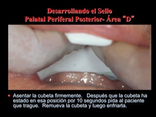 Desarrollando el Sello
Palatal Periferal Posterior- Área D

" Asentar la cubeta firmemente. Después que la cubeta ha
estado en esa posición por 10 segundos pida al paciente
que trague. Remueva la cubeta y luego enfriarla.

 