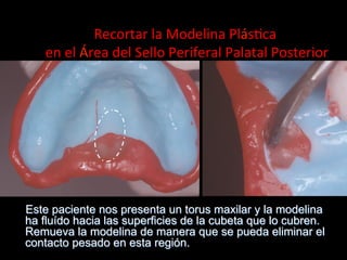 Recortar	
  la	
  Modelina	
  Plás4ca	
  
	
  en	
  el	
  Área	
  del	
  Sello	
  Periferal	
  Palatal	
  Posterior	
  

Este paciente nos presenta un torus maxilar y la modelina
ha fluído hacia las superficies de la cubeta que lo cubren.
Remueva la modelina de manera que se pueda eliminar el
contacto pesado en esta región.

 