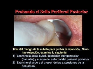 Probando el Sello Periferal Posterior

Tirar del mango de la cubeta para probar la retención. Si no
hay retención, examine lo siguiente:
1) Examine la bolsa bucal, depresión pterigomaxilar
(hamular) y el área del sello palatal periferal posterior
2) Examine el largo y el grosor de las extensiones de la
dentadura.

 