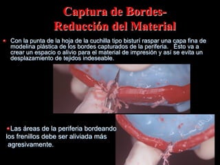 Captura de BordesReducción del Material
"

Con la punta de la hoja de la cuchilla tipo bisturí raspar una capa fina de
modelina plástica de los bordes capturados de la periferia. Ésto va a
crear un espacio o alivio para el material de impresión y así se evita un
desplazamiento de tejidos indeseable.

" Las áreas de la periferia bordeando
los frenillos debe ser aliviada más
agresivamente.

 