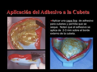 Aplicación del Adhesivo a la Cubeta
" Aplicar una capa fina de adhesivo
para cubetas y permita que se
seque. Noten que el adhesivo se
aplica de 2-3 mm sobre el borde
externo de la cubeta.

 