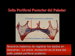 Sello Periferal Posterior del Paladar
Glándulas posteriores palatinas

Tuberosidades Maxilares

Nosotros tratamos de registrar los tejidos en
descanso. La única excepciόn es el área del
sello palatal periferal posterior.

 