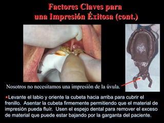 Factores Claves para
una Impresión Éxitosa (cont.)

Nosotros no necesitamos una impresión de la úvula.
" Levante el labio y oriente la cubeta hacia arriba para cubrir el
frenillo. Asentar la cubeta firmemente permitiendo que el material de
impresión pueda fluír. Usen el espejo dental para remover el exceso
de material que puede estar bajando por la garganta del paciente.

 