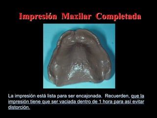 Impresión Maxilar Completada

La impresión está lista para ser encajonada. Recuerden, que la
impresión tiene que ser vaciada dentro de 1 hora para así evitar
distorción.

 