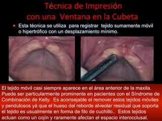  Técnica	
  de	
  Impresión	
  	
  
con	
  una	
  	
  Ventana	
  en	
  la	
  Cubeta	
  
" Esta técnica se utiliza para registrar tejido sumamente móvil
o hipertrófico con un desplazamiento mínimo.

El tejido móvil casi siempre aparece en el área anterior de la maxila.
Puede ser particularmente prominente en pacientes con el Síndrome de
Combinación de Kelly. Es aconsejable el remover estos tejidos mόviles
y pendulosos yá que el hueso del reborde alveolar residual que soporta
el tejido es usualmente en forma de filo de cuchillo.. Estos tejidos
actuan como un cojín y raramente afectan el espacio interocclusal.

 