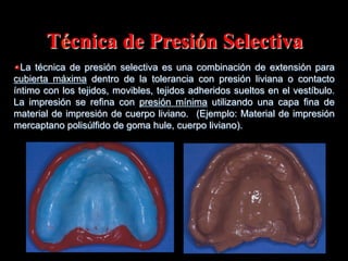 Técnica de Presiόn Selectiva
" La técnica de presiόn selectiva es una combinación de extensiόn para
cubierta máxima dentro de la tolerancia con presión liviana o contacto
íntimo con los tejidos, movibles, tejidos adheridos sueltos en el vestíbulo.
La impresiόn se refina con presión mínima utilizando una capa fina de
material de impresiόn de cuerpo liviano. (Ejemplo: Material de impresión
mercaptano polisúlfido de goma hule, cuerpo liviano).

 