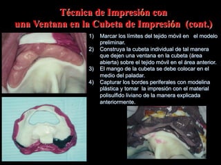 Técnica de Impresiόn con
una Ventana en la Cubeta de Impresiόn (cont.)
1)  Marcar los límites del tejido mόvil en el modelo
preliminar.
2)  Construya la cubeta individual de tal manera
que dejen una ventana en la cubeta (área
abierta) sobre el tejido mόvil en el área anterior.
3)  El mango de la cubeta se debe colocar en el
medio del paladar.
4)  Capturar los bordes periferales con modelina
plástica y tomar la impresión con el material
polisulfido liviano de la manera explicada
anteriormente.

 