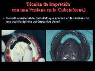 Técnica de Impresiόn
con una Ventana en la Cubeta(cont.)
" Recorte el material de polisulfido que aparece en la ventana con
una cuchilla de hoja quirúrgica tipo bisturí.

 