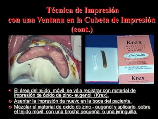Técnica de Impresiόn
con una Ventana en la Cubeta de Impresiόn
(cont.)

" El área del tejido mόvil se vá a registrar con material de
impresiόn de όxido de zinc- eugenol (Krex).
" Asentar la impresiόn de nuevo en la boca del paciente.
" Mezclar el material de oxido de zinc - eugenol y aplicarlo sobre
el tejido mόvil con una brocha pequeña o una jeringuilla.

 