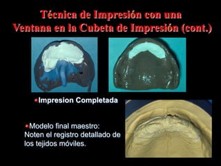 Técnica de Impresión con una
Ventana en la Cubeta de Impresiόn (cont.)

"  Impresion Completada
"  Modelo final maestro:
Noten el registro detallado de
los tejidos móviles.

 
