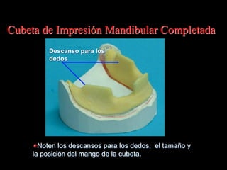 Cubeta de Impresiόn Mandibular Completada
Descanso para los
dedos

"  Noten los descansos para los dedos, el tamaño y
la posiciόn del mango de la cubeta.

 