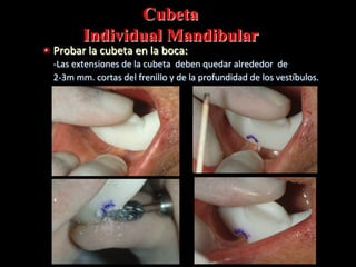 Cubeta
Individual Mandibular

" Probar	
  la	
  cubeta	
  en	
  la	
  boca:	
  

	
  -­‐Las	
  extensiones	
  de	
  la	
  cubeta	
  	
  deben	
  quedar	
  alrededor	
  	
  de	
  	
  	
  
	
  	
  	
  	
  	
  2-­‐3m	
  mm.	
  cortas	
  del	
  frenillo	
  y	
  de	
  la	
  profundidad	
  de	
  los	
  vestíbulos.	
  

 