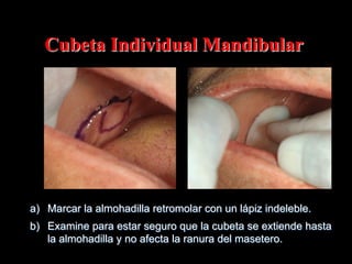Cubeta Individual Mandibular

a)  Marcar la almohadilla retromolar con un lápiz indeleble.
b)  Examine para estar seguro que la cubeta se extiende hasta
la almohadilla y no afecta la ranura del masetero.

 