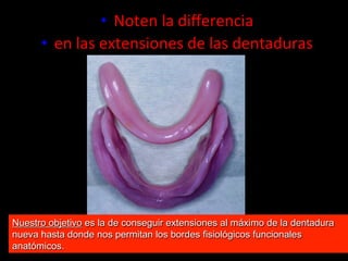 •  Noten	
  la	
  diﬀerencia	
  	
  
•  en	
  las	
  extensiones	
  de	
  las	
  dentaduras	
  

Nuestro objetivo es la de conseguir extensiones al máximo de la dentadura
nueva hasta donde nos permitan los bordes fisiolόgicos funcionales
anatόmicos.

 