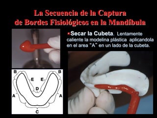 La Secuencia de la Captura
de Bordes Fisiolόgicos en la Mandíbula
"  Secar la Cubeta. Lentamente
caliente la modelina plástica aplicandola
en el area A en un lado de la cubeta.

 
