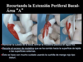 Recortando la Extensiόn Periferal BucalÁrea A

" Remover la cubeta de la boca, enfríar la modelina plástica en agua fría.
" Recorte el exceso de modelina que se ha corrido hacia la superficie de tejido
o las superficies externas.
" Ésto se hace con mucho cuidado usando la cuchilla de mango rojo tipo
bisturí.

 