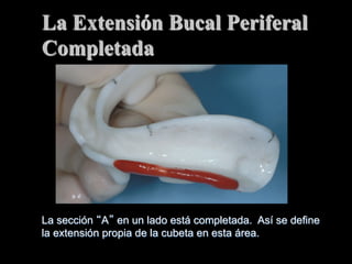 La Extensiόn Bucal Periferal
Completada

La secciόn A en un lado está completada. Así se define
la extensiόn propia de la cubeta en esta área.

 