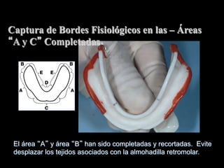 Captura de Bordes Fisiológicos en las – Áreas
A y C Completadas

El área A y área B han sido completadas y recortadas. Evite
desplazar los tejidos asociados con la almohadilla retromolar.

 