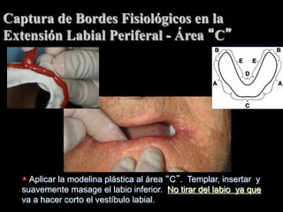 Captura de Bordes Fisiológicos en la
Extensión Labial Periferal - Área C

"   Aplicar la modelina plástica al área C . Templar, insertar y

suavemente masage el labio inferior. No tirar del labio ya que
va a hacer corto el vestíbulo labial.

 
