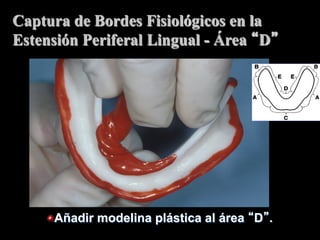 Captura de Bordes Fisiolόgicos en la
Estensión Periferal Lingual - Área D

"  Añadir modelina plástica al área D .

 