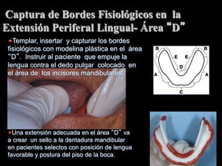 Captura de Bordes Fisiológicos en la
Extensión Periferal Lingual- Área D
"  Templar, insertar y capturar los bordes
fisiolόgicos con modelina plástica en el área
D . Instruir al paciente que empuje la
lengua contra el dedo pulgar colocado en
el área de los incisores mandibulares.

"  Una extensión adecuada en el área D va
a crear un sello a la dentadura mandibular
en pacientes selectos con posición de lengua
favorable y postura del piso de la boca.

 