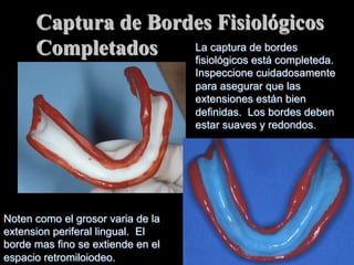 Captura de Bordes Fisiológicos
La captura de bordes
Completados
fisiolόgicos está completeda.
Inspeccione cuidadosamente
para asegurar que las
extensiones están bien
definidas. Los bordes deben
estar suaves y redondos.

Noten como el grosor varia de la
extension periferal lingual. El
borde mas fino se extiende en el
espacio retromiloiodeo.

 