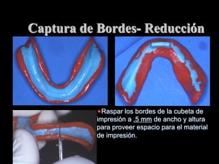 Captura de Bordes- Reducción

"  Raspar los bordes de la cubeta de
impresiόn a .5 mm de ancho y altura
para proveer espacio para el material
de impresión.

 