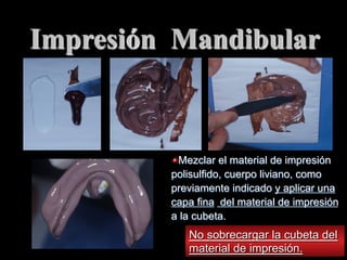 Impresiόn Mandibular

"  Mezclar el material de impresiόn
polisulfido, cuerpo liviano, como
previamente indicado y aplicar una
capa fina del material de impresión
a la cubeta.

No sobrecargar la cubeta del
material de impresiόn.

 