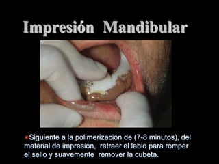 Impresiόn Mandibular

"  Siguiente a la polimerización de (7-8 minutos), del
material de impresiόn, retraer el labio para romper
el sello y suavemente remover la cubeta.

 