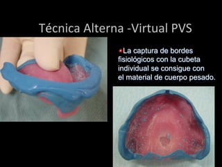  Técnica	
  Alterna	
  -­‐Virtual	
  PVS	
  
"  La captura de bordes
fisiológicos con la cubeta
individual se consigue con
el material de cuerpo pesado.

 