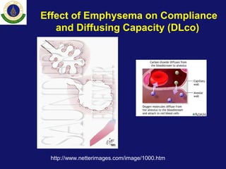 Effect of Emphysema on Compliance
and Diffusing Capacity (DLco)
http://www.netterimages.com/image/1000.htm
 
