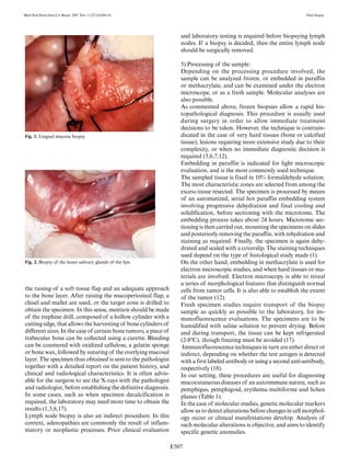 E507
Med Oral Patol Oral Cir Bucal. 2007 Nov 1;12(7):E504-10. Oral biopsy
16
17
Fig. 2. Biopsy of the lesser salivary glands of the lips.
Fig. 1. Lingual mucosa biopsy.
the raising of a soft tissue flap and an adequate approach
to the bone layer. After raising the mucoperiosteal flap, a
chisel and mallet are used, or the target zone is drilled to
obtain the specimen. In this sense, mention should be made
of the trephine drill, composed of a hollow cylinder with a
cutting edge, that allows the harvesting of bone cylinders of
different sizes. In the case of certain bone tumors, a piece of
trabecular bone can be collected using a curette. Bleeding
can be countered with oxidized cellulose, a gelatin sponge
or bone wax, followed by suturing of the overlying mucosal
layer. The specimen thus obtained is sent to the pathologist
together with a detailed report on the patient history, and
clinical and radiological characteristics. It is often advis-
able for the surgeon to see the X-rays with the pathologist
and radiologist, before establishing the definitive diagnosis.
In some cases, such as when specimen decalcification is
required, the laboratory may need more time to obtain the
results (1,3,6,17).
Lymph node biopsy is also an indirect procedure. In this
context, adenopathies are commonly the result of inflam-
matory or neoplastic processes. Prior clinical evaluation
and laboratory testing is required before biopsying lymph
nodes. If a biopsy is decided, then the entire lymph node
should be surgically removed.
5) Processing of the sample:
Depending on the processing procedure involved, the
sample can be analyzed frozen, or embedded in paraffin
or methacrylate, and can be examined under the electron
microscope, or as a fresh sample. Molecular analyses are
also possible.
As commented above, frozen biopsies allow a rapid his-
topathological diagnosis. This procedure is usually used
during surgery in order to allow immediate treatment
decisions to be taken. However, the technique is contrain-
dicated in the case of very hard tissues (bone or calcified
tissue), lesions requiring more extensive study due to their
complexity, or when no immediate diagnostic decision is
required (3,6,7,12).
Embedding in paraffin is indicated for light microscopic
evaluation, and is the most commonly used technique.
The sampled tissue is fixed in 10% formaldehyde solution.
The most characteristic zones are selected from among the
excess tissue resected. The specimen is processed by means
of an automatized, serial hot paraffin embedding system
involving progressive dehydration and final cooling and
solidification, before sectioning with the microtome. The
embedding process takes about 24 hours. Microtome sec-
tioning is then carried out, mounting the specimens on slides
and posteriorly removing the paraffin, with rehydration and
staining as required. Finally, the specimen is again dehy-
drated and sealed with a coverslip. The staining techniques
used depend on the type of histological study made (1).
On the other hand, embedding in methacrylate is used for
electron microscopic studies, and when hard tissues or ma-
terials are involved. Electron microscopy is able to reveal
a series of morphological features that distinguish normal
cells from tumor cells. It is also able to establish the extent
of the tumor (12).
Fresh specimen studies require transport of the biopsy
sample as quickly as possible to the laboratory, for im-
munofluorescence evaluations. The specimens are to be
humidified with saline solution to prevent drying. Before
and during transport, the tissue can be kept refrigerated
(2-8ºC), though freezing must be avoided (17).
Immunofluorescence techniques in turn are either direct or
indirect, depending on whether the test antigen is detected
with a first labeled antibody or using a second anti-antibody,
respectively (18).
In our setting, these procedures are useful for diagnosing
mucocutaneous diseases of an autoimmune nature, such as
pemphigus, pemphigoid, erythema multiforme and lichen
planus (Table 1).
In the case of molecular studies, genetic molecular markers
allow us to detect alterations before changes in cell morphol-
ogy occur or clinical manifestations develop. Analysis of
such molecular alterations is objective, and aims to identify
specific genetic anomalies.
 