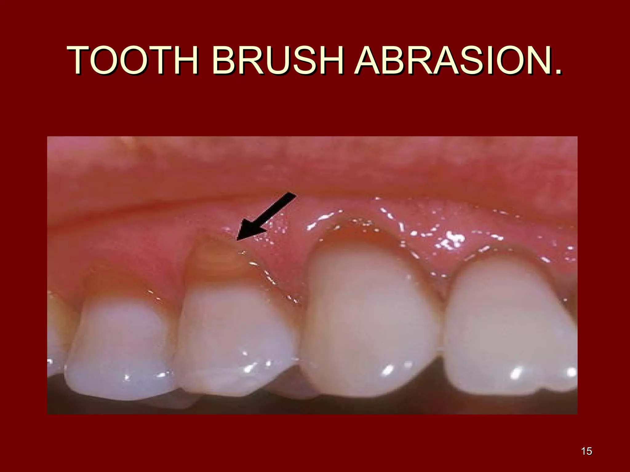 TOOTH BRUSH ABRASION.TOOTH BRUSH ABRASION.
1515
 