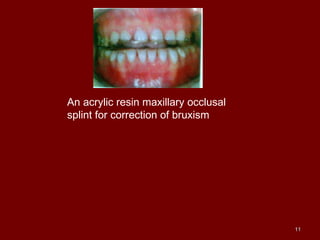 An acrylic resin maxillary occlusal
splint for correction of bruxism
1111
 