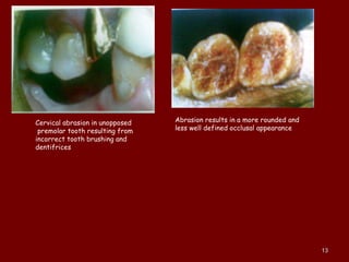 
Cervical abrasion in unopposed
premolar tooth resulting from
incorrect tooth brushing and
dentifrices
Abrasion results in a more rounded and
less well defined occlusal appearance
1313
 