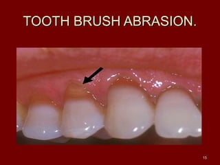 TOOTH BRUSH ABRASION.TOOTH BRUSH ABRASION.
1515
 