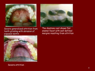 
Severe generalized attrition fromSevere generalized attrition from
tooth grinding with abrasion oftooth grinding with abrasion of
exposed dentinexposed dentin
The diestone cast shows flat
enamel facet with well defined
margins resulting from attrition
Severe attrition
88
 