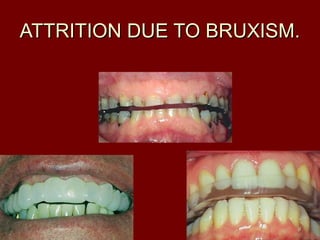 ATTRITION DUE TO BRUXISM.ATTRITION DUE TO BRUXISM.
99
 