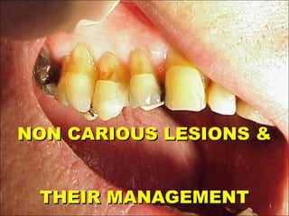 NON CARIOUS LESIONS &NON CARIOUS LESIONS &
THEIR MANAGEMENTTHEIR MANAGEMENT 11
 