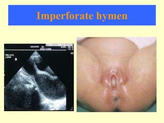 Imperforate hymen
 